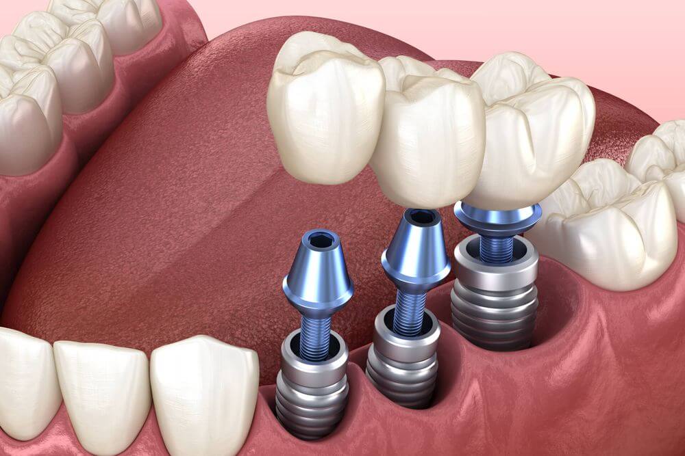 Restore Your Missing Teeth with Best Dental Implants in Palmdale