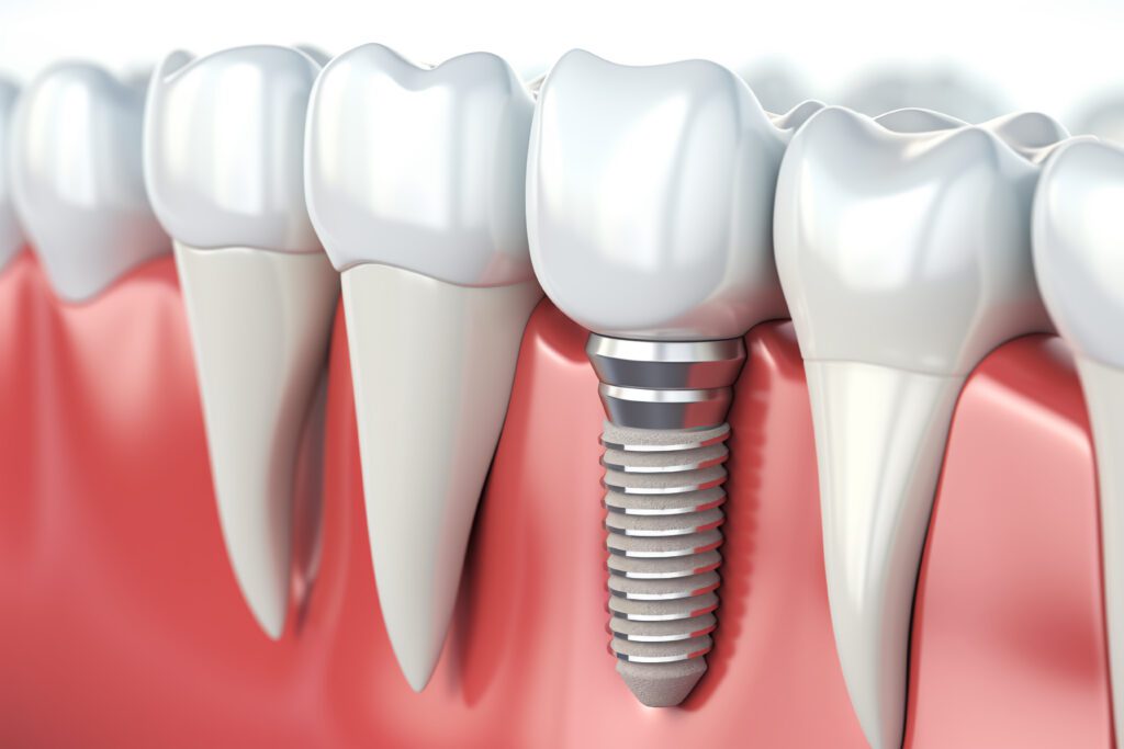 Best Dental Implants near me
