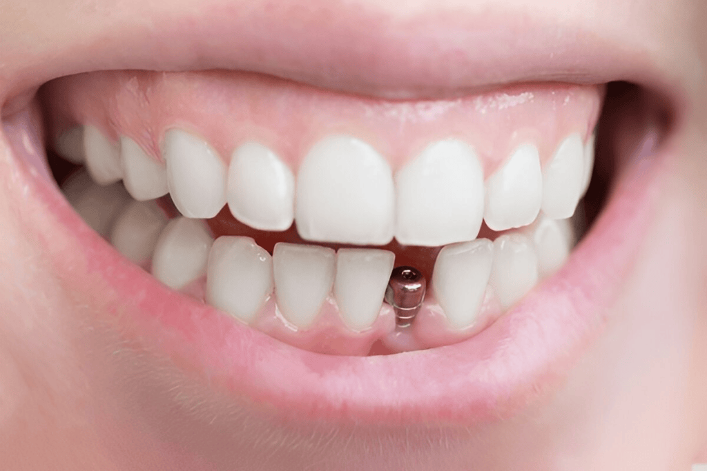 dental implants near me